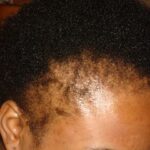 Understanding and Managing Hair Loss in Nigerians